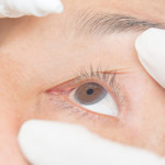 Tìm hiểu triệu chứng và nguyên nhân gây bệnh viêm kết mạc cấp tính