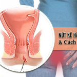 Triệu chứng & Nguyên nhân gây bệnh nứt kẽ hậu môn