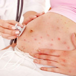 Bà bầu khi bị thủy đậu có nguy hiểm hay không?