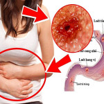 Bệnh đau dạ dày không do viêm loét có triệu chứng gì?