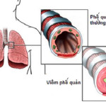 Bệnh viêm phế quản là gì? Nguyên nhân và triệu chứng của bệnh