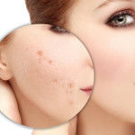 Chia sẻ các cách trị sẹo hiệu quả từ thiên nhiên an toàn