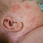 Triệu chứng sốt xuất huyết ở trẻ em và cách điều trị